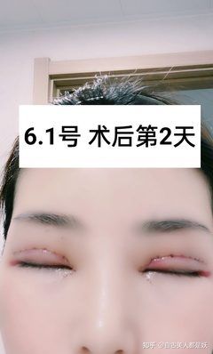 全切双眼皮拆线后注意事项
