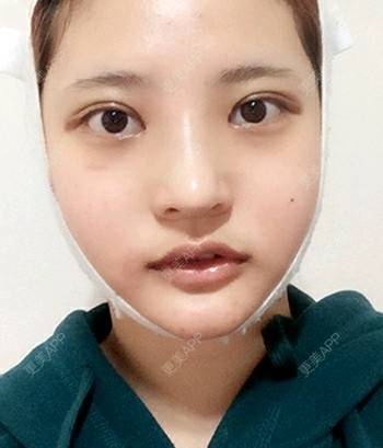 笑能瘦脸吗