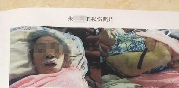 轻伤一级私了赔偿49万