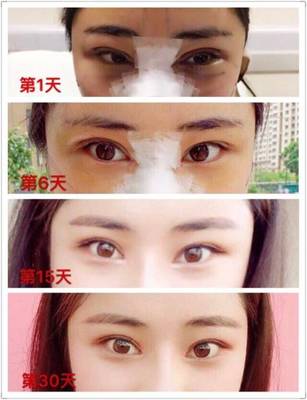 小眼睛适合做双眼皮吗
