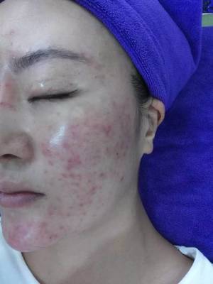 长痘痘的四个阶段