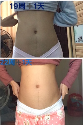 没怀孕会有妊娠线吗