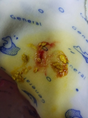 宝宝化验大便怎么取样