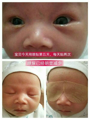 宝宝有绿色眼屎怎么回事
