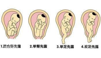 胎儿臀位