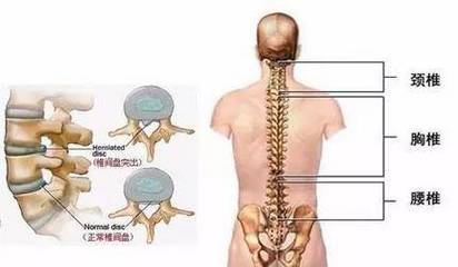 颈椎突出怎么治疗效果好