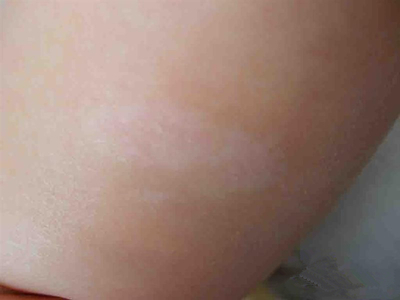 宝宝无色素痣