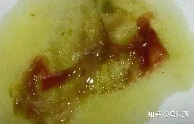 大便出好多血是怎么回事