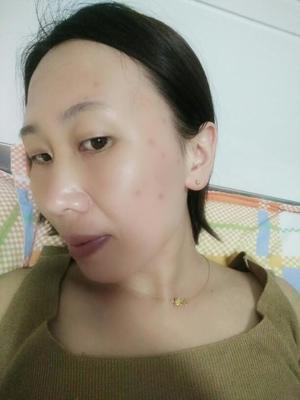 怀孕可以祛痣吗