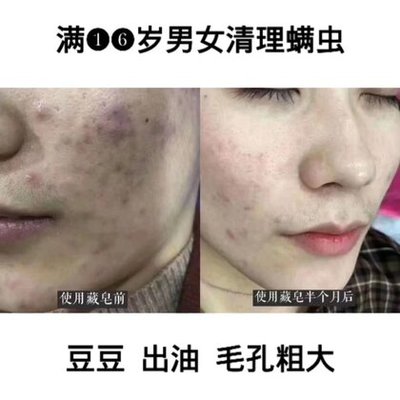 16岁毛孔粗大怎么办