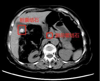 胆囊多发结石该怎么治疗
