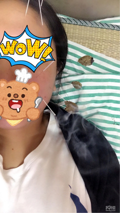 怀孕面瘫