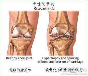 骨刺增生怎么治疗