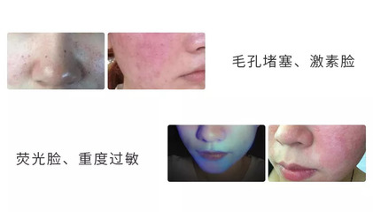 脸上毛孔堵塞长痘痘