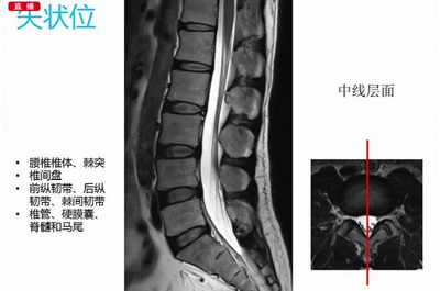 腰椎后纵韧带有多少