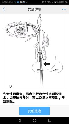 泪管堵塞怎么治疗