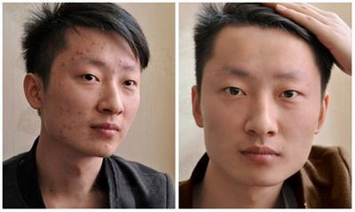 男人脸上长痘痘怎么调理