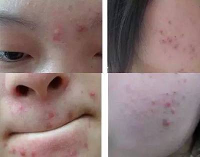 擦脸油痘痘多