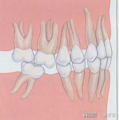 牙缝大怎么治疗