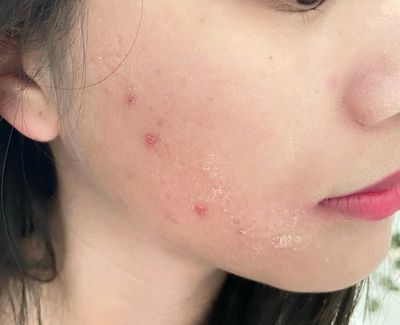 痘痘泛红是怎麽回事