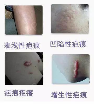 怎么确定是不是疤痕体质
