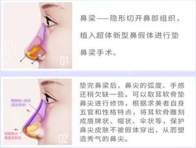 假体隆鼻恢复过程