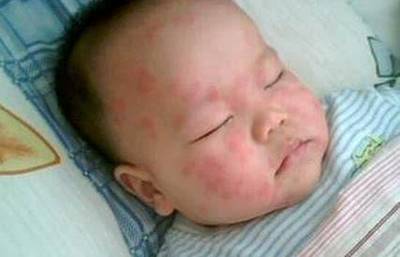 新生儿起了湿疹怎么办