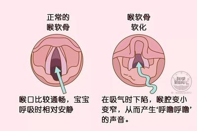 怎样治咳嗽最有效