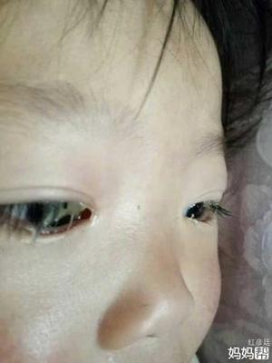 宝宝眼睛好多眼屎