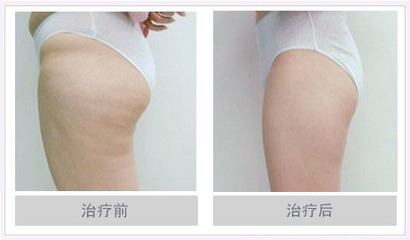 瘦腿吸脂