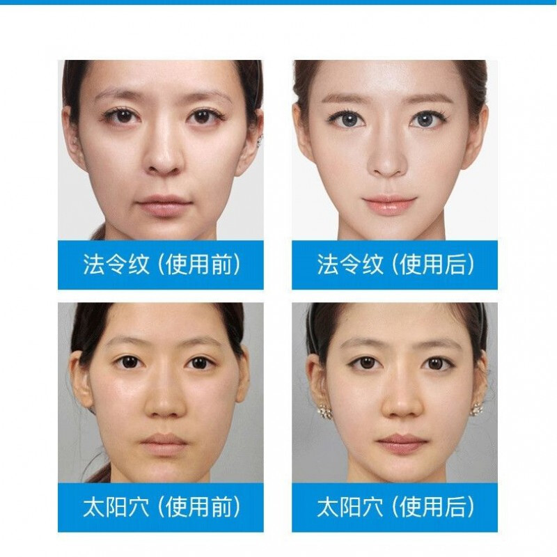 胶原蛋白填充法令纹