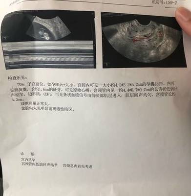 怀孕期间有血丝正常吗