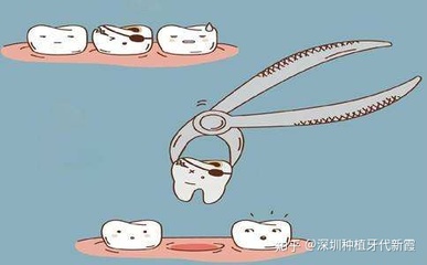 智齿拔牙疼吗