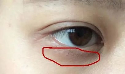 眼睛发黑是怎么回事