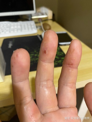 手指上起皮是怎么回事
