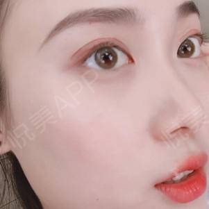 开眼角拆线后多久化妆