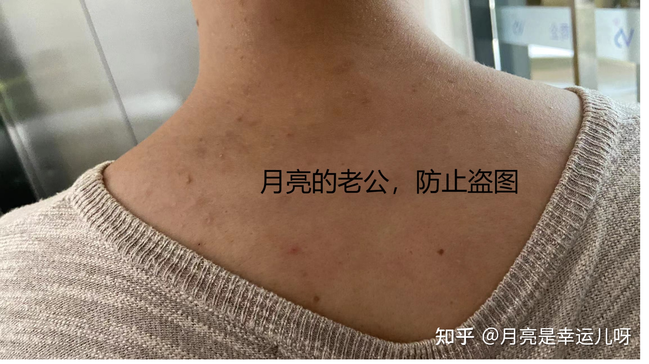 后背突然开始长痘痘怎么办