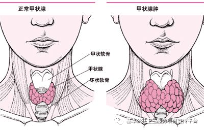 甲状腺术后多久可以怀孕