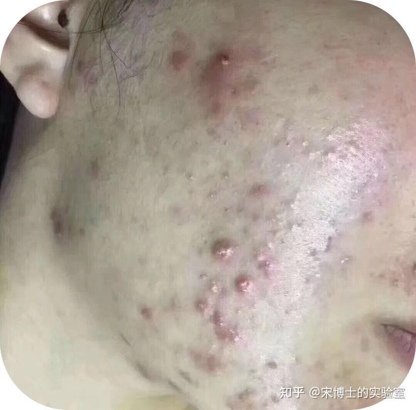 脸上起痘痘留疤怎么办