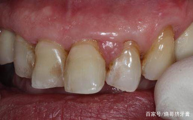 牙龈边长个小肉球是怎么回事
