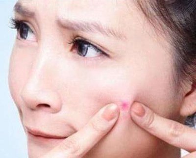 怎样防止痘痘再长