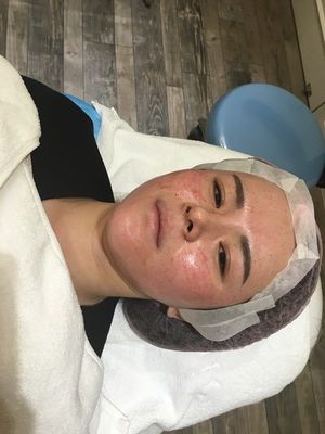打水光疼吗