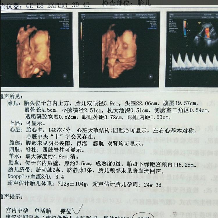 胎儿心脏检查