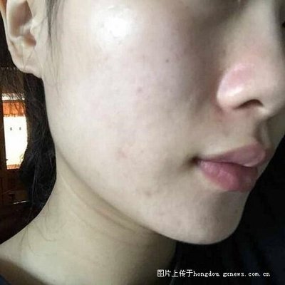 右脸长痘痘是怎么回事啊