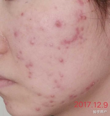 痘痘怎么一直消不下去