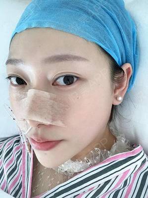 哪里自体隆鼻效果好
