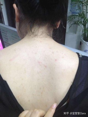 为什么一背都是痘痘