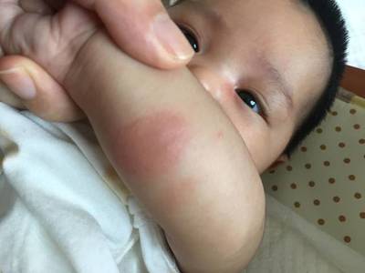 6个月宝宝出疹子症状