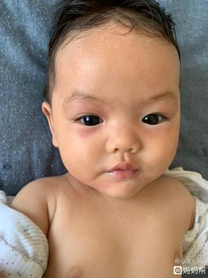 六个月宝宝过敏怎么办
