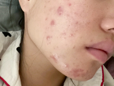 长痘痘变好的帖子